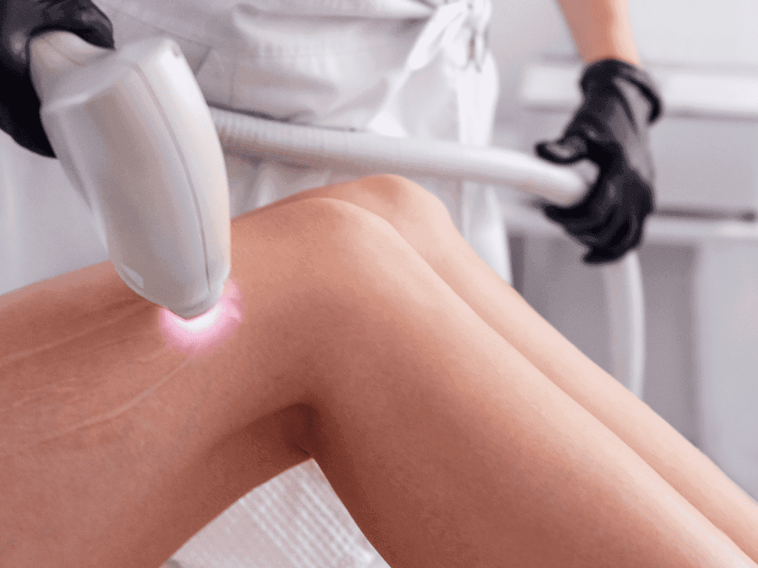 Hair Removal